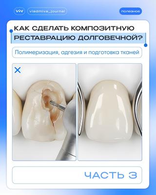Полимеризация, адгезия и техника внесения — три кита долговечной реставрации.